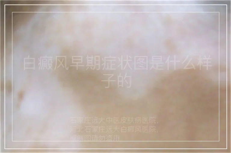 白癜风早期症状图是什么样子的