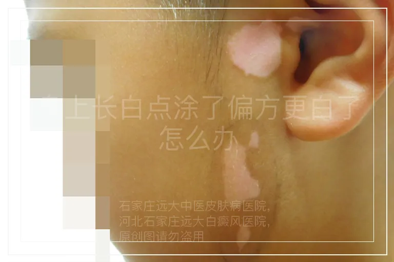 身上长白点涂了偏方更白了怎么办