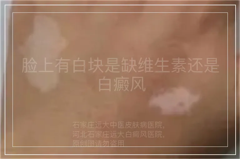 脸上有白块是缺维生素还是白癜风