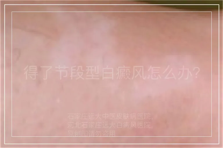 得了节段型白癜风怎么办？