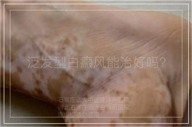 泛发型白癜风能治好吗？