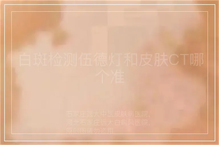 白斑检测伍德灯和皮肤CT哪个准