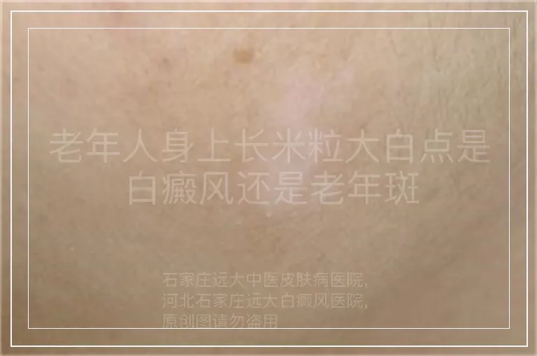 老年人身上长米粒大白点是白癜风还是老年斑