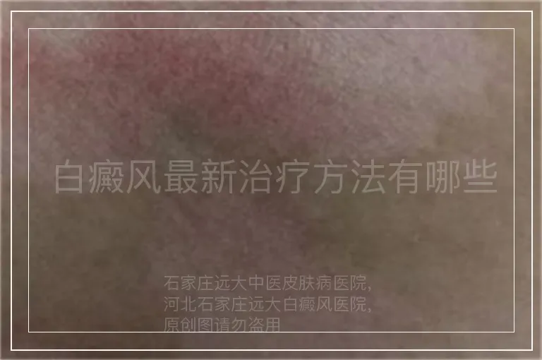 白癜风最新治疗方法有哪些