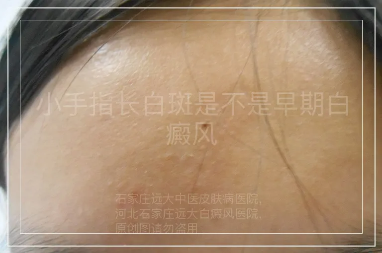 小手指长白斑是不是早期白癜风