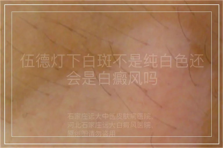 伍德灯下白斑不是纯白色还会是白癜风吗