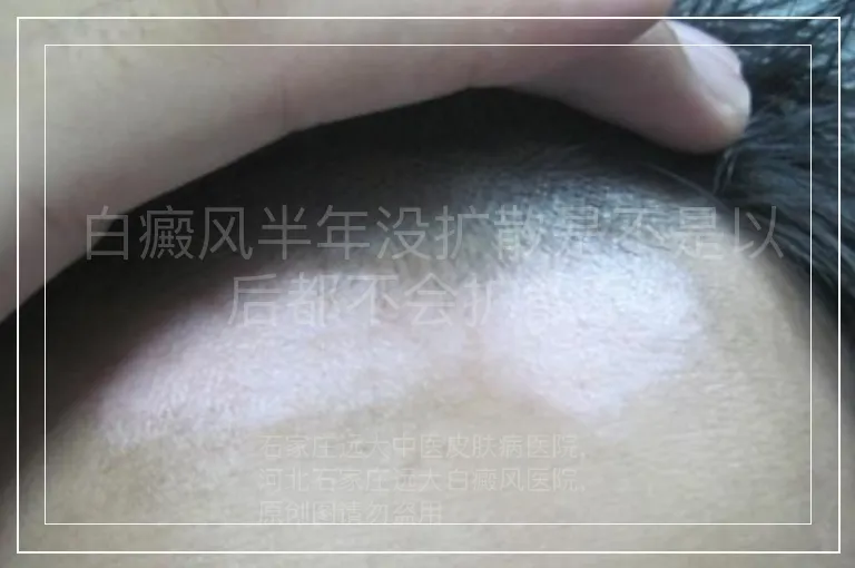 白癜风半年没扩散是不是以后都不会扩散了
