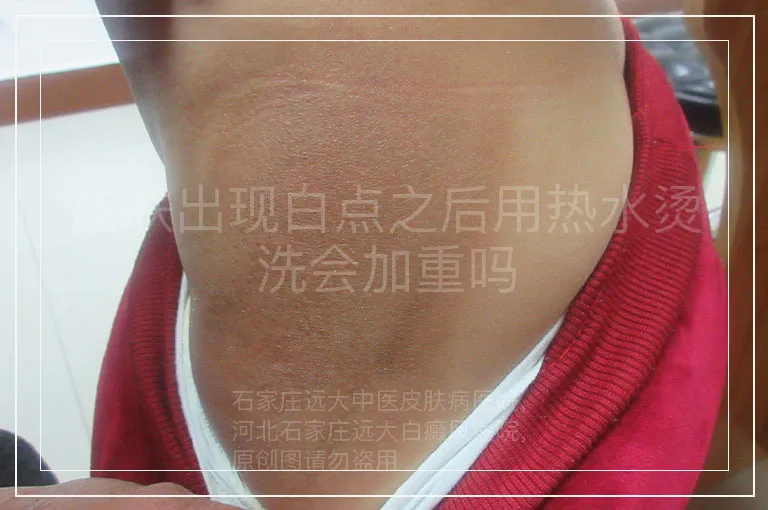 皮肤出现白点之后用热水烫洗会加重吗