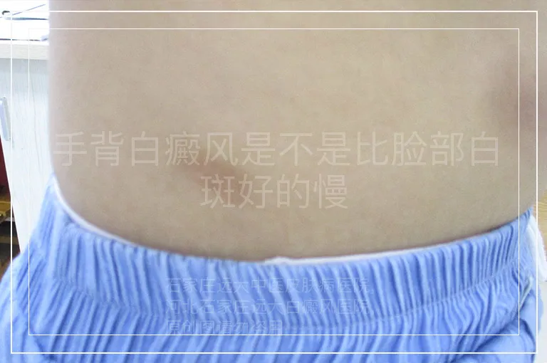 手背白癜风是不是比脸部白斑好的慢