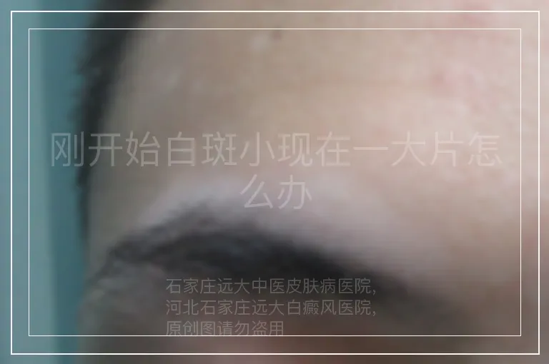 刚开始白斑小现在一大片怎么办