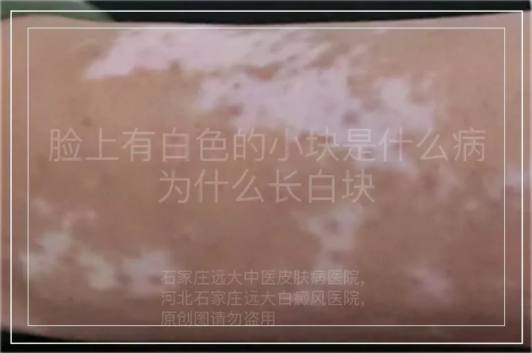 脸上有白色的小块是什么病为什么长白块
